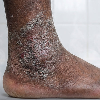 Eczema Cheville